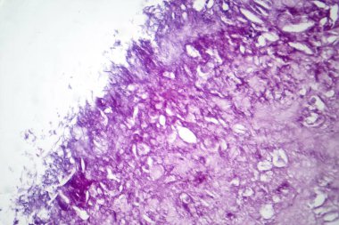 Melanomun fotomikrografı, kötü huylu melanositlerin sergilenmesi, agresif cilt kanserinden sorumlu birincil hücreler..