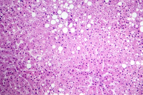 肝脏脂肪沉着症的显微照片 显示肝细胞中的脂肪堆积 称为脂肪性肝病 — 图库照片