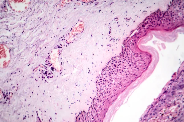 Fotomikrograf Bazocelulárního Karcinomu Zobrazující Maligní Bazální Buňky Typické Pro Nejčastější — Stock fotografie