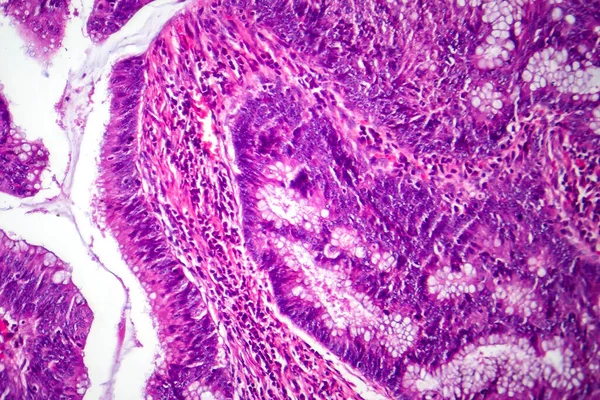 Fotomicrogramma Dell Adenocarcinoma Del Colon Che Illustra Cellule Ghiandolari Maligne — Foto Stock