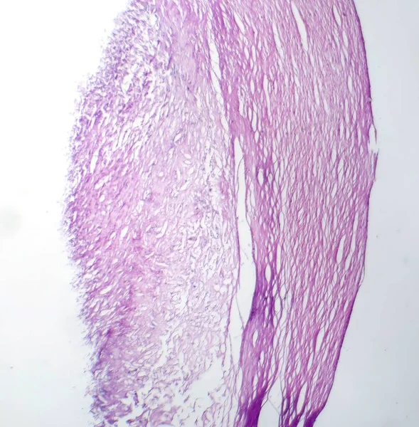 黑色素瘤的显微照片 显示恶性黑素细胞 对侵袭性皮肤癌负责的主要细胞 — 图库照片