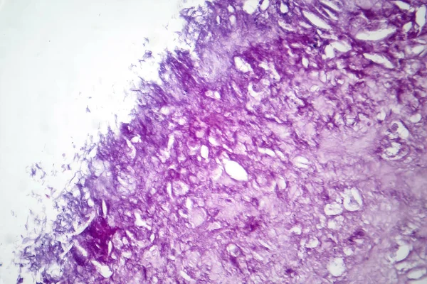 Fotomikrográf Melanóma Bemutató Rosszindulatú Melanociták Elsődleges Sejtek Felelős Agresszív Bőrrák — Stock Fotó