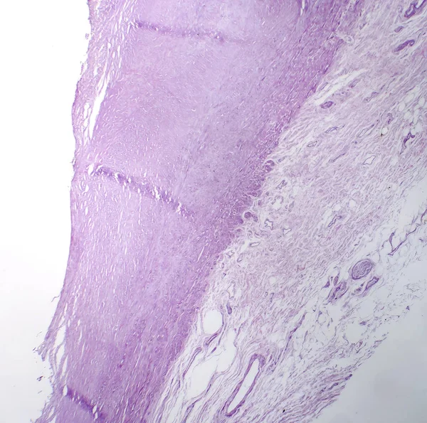 Fotomicrografía Aterosclerosis Aórtica Revelando Acumulación Placa Estrechamiento Aorta Debido Depósitos —  Fotos de Stock