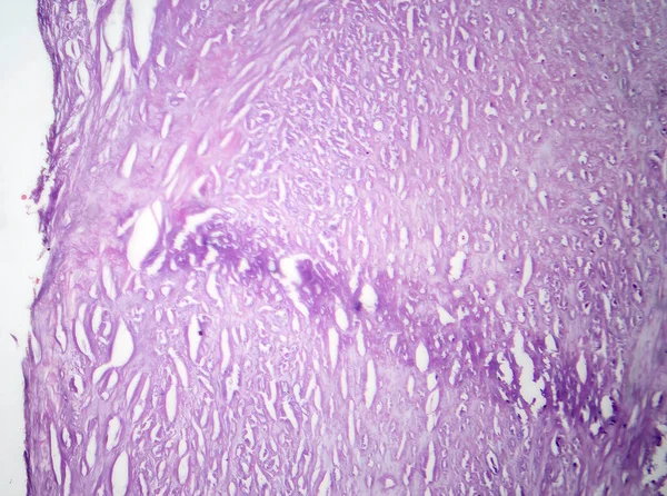 Photomicrograph Aortic Atherosclerosis Revealing Plaque Buildup Narrowing Aorta Due Cholesterol — Stock Photo, Image