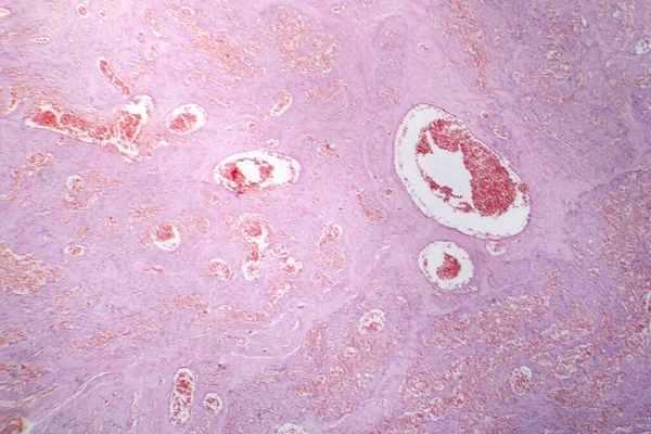 Fotomicrografia Hemangioma Capilar Ilustrando Proliferação Anormal Capilares Característica Tumor Vascular — Fotografia de Stock