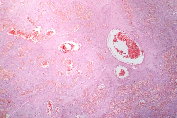 毛細血管血管腫瘍の特徴である毛細血管の異常な増殖を示す毛細血管の写真撮影 — ストック写真