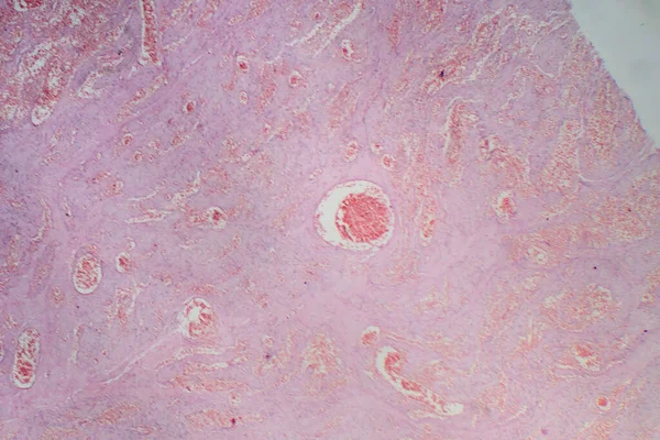 Photomicrograph Capillary Hemangioma Illustrating Abnormal Proliferation Capillaries Characteristic Benign Vascular — Stock Photo, Image