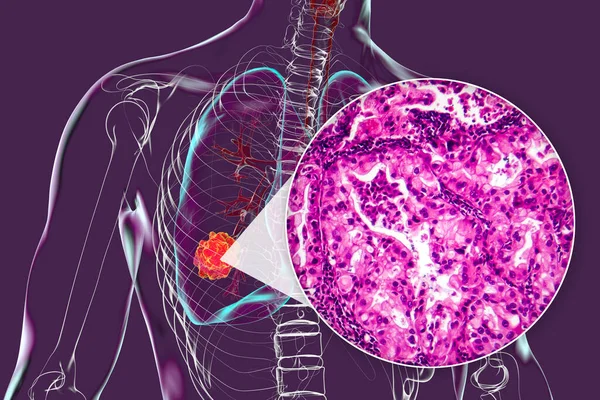 Ludzkie Ciało Przezroczystą Skórą Prezentującą Raka Płuc Ilustracja Uzupełniona Lekkim — Zdjęcie stockowe