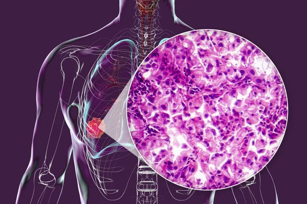 Human Body Transparent Skin Showcasing Lung Cancer Illustration Complemented Light — Stock Photo, Image