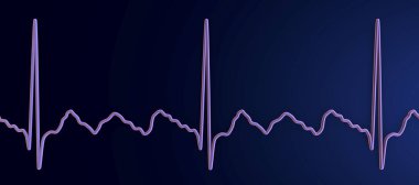 Atriyal kanat çırpmada EKG, atria 'nın düzenli kasılmalarıyla karakterize edilen anormal bir kalp ritmi. Karakteristik testere dişli P-dalgaları ve düzensiz ventriküler ritim gösteren 3D çizimler.