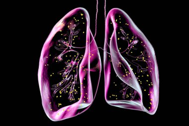 Lung adiaspiromycosis, a rare respiratory infection caused by the fungus Emmonsia spp., characterized by the presence of enlarged encapsulated fungal spores within lung tissues, 3D illustration. clipart