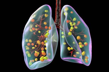 Akciğer histoplazmozu, Histoplasma kapsülünün sebep olduğu bir mantar enfeksiyonu. 3 boyutlu illüstrasyon ciğerlere dağılmış küçük düğümleri gösteriyor..