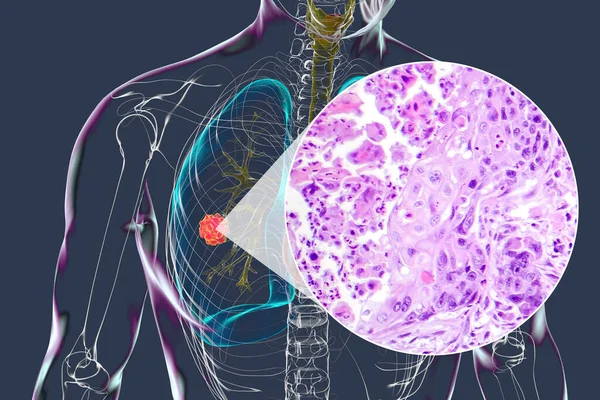 Corpo Humano Com Pele Transparente Apresentando Câncer Pulmão Ilustração Complementada — Fotografia de Stock