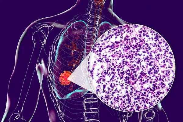 Ludzkie Ciało Przezroczystą Skórą Wykazujące Raka Płuc Ilustracja Uzupełniona Lekkim — Zdjęcie stockowe