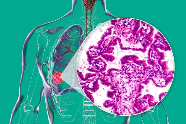 stock image A human body with transparent skin showcasing lung cancer, 3D illustration complemented by a light micrograph of the lung adenocarcinoma.