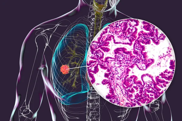Ludzkie Ciało Przezroczystym Rakiem Płuc Ilustracja Uzupełniona Lekkim Mikrografem Gruczolakoraka — Zdjęcie stockowe