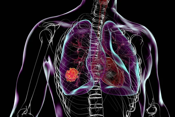 Человеческое Тело Прозрачной Кожей Демонстрирующее Рак Легких Иллюстрация — стоковое фото
