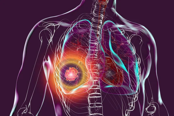 Ludzkie Ciało Przezroczystą Skórą Przedstawiającą Raka Płuc Ilustracja — Zdjęcie stockowe
