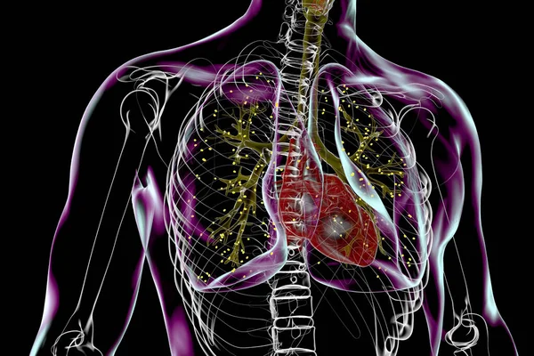 Ακτινομυκητίαση Των Πνευμόνων Μια Σπάνια Λοίμωξη Του Αναπνευστικού Που Προκαλείται — Φωτογραφία Αρχείου