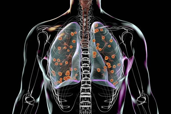 Lung Histoplasmosis Fungal Infection Caused Histoplasma Capsulatum Illustration Showing Small — Stock Photo, Image