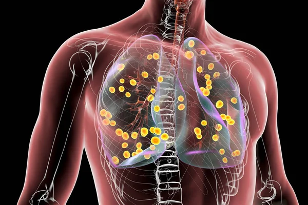 Lung Histoplasmosis Fungal Infection Caused Histoplasma Capsulatum Illustration Showing Small — Stock Photo, Image