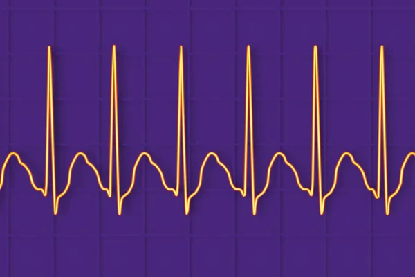 Ecg Aleteo Auricular Ritmo Cardíaco Anormal Caracterizado Por Contracciones Rápidas — Foto de Stock