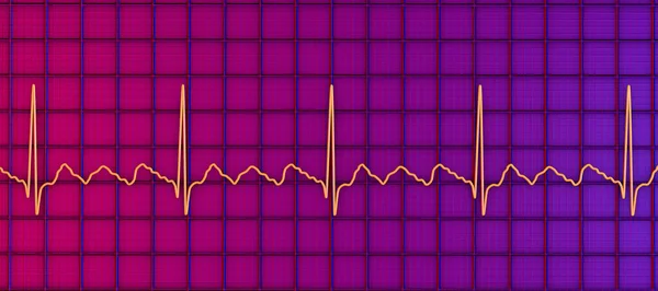 Ekg Trzepotaniu Przedsionków Nieprawidłowy Rytm Serca Charakteryzujący Się Szybkimi Regularnymi — Zdjęcie stockowe
