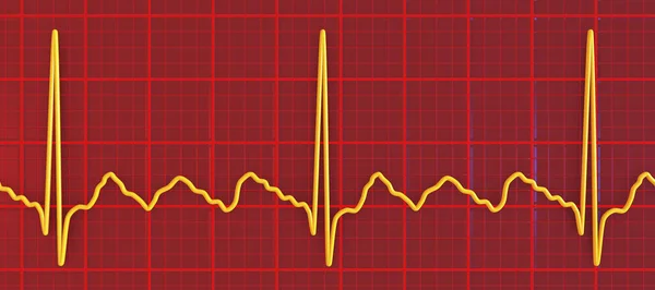 Ekg Síňovém Záblesku Abnormální Srdeční Rytmus Charakterizovaný Rychlými Pravidelnými Kontrakcemi — Stock fotografie