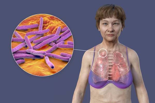 A 3D illustration showing a female patient with transparent skin, revealing the lungs affected by apical tuberculosis and close-up view of Mycobacterium tuberculosis bacteria.