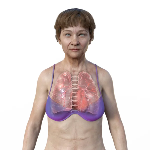 一个显示透明皮肤的女性患者的3D图像 揭示了受肺结核病影响的肺 — 图库照片