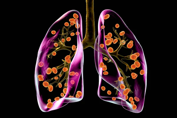 Histoplazmoza Płuc Zakażenie Grzybicze Wywołane Przez Histoplasma Capsulatum Ilustracja Pokazująca — Zdjęcie stockowe
