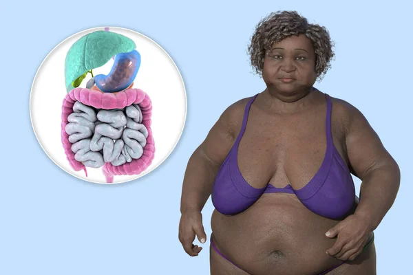過体重の女性と消化器系のクローズアップビュー 3Dイラストは 肥満に関連する消化器系の問題を強調しています — ストック写真