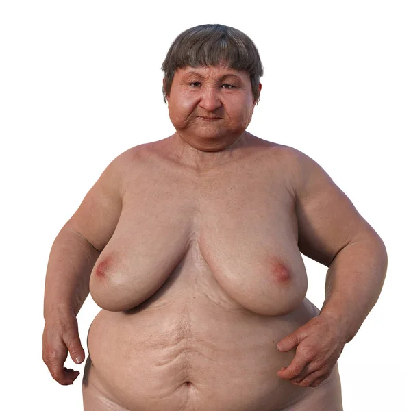 Een Vrouw Met Overgewicht Lichaamssamenstelling Medische Illustratie Benadrukken Van Fysiologische — Stockfoto