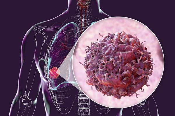 Ludzkie Ciało Przezroczystą Skórą Przedstawiającą Raka Płuc Uzupełnione Bliskim Widokiem — Zdjęcie stockowe