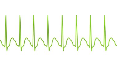 Atriyal kanat çırpmada EKG, atria 'nın düzenli kasılmalarıyla karakterize edilen anormal bir kalp ritmi. Karakteristik testere dişli P-dalgaları ve düzensiz ventriküler ritim gösteren 3D çizimler.