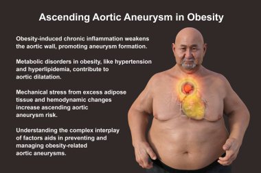 3D bilimsel illüstrasyon, saydam derili obez bir adamı, yükselen bir aort anevrizmasını, obezite ile yükselen aort anevrizmasının ilişkisini vurgulayan bir konsepti gözler önüne seriyor..