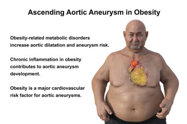 3D bilimsel illüstrasyon, saydam derili obez bir adamı, yükselen bir aort anevrizmasını, obezite ile yükselen aort anevrizmasının ilişkisini vurgulayan bir konsepti gözler önüne seriyor..