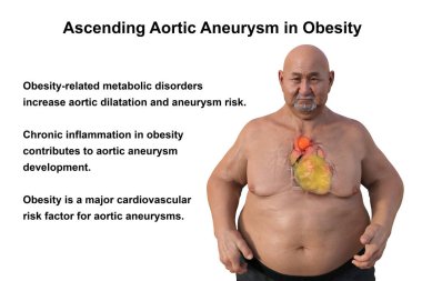 3D bilimsel illüstrasyon, saydam derili obez bir adamı, yükselen bir aort anevrizmasını, obezite ile yükselen aort anevrizmasının ilişkisini vurgulayan bir konsepti gözler önüne seriyor..