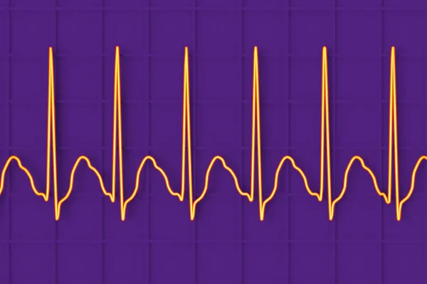 Ekg Trzepotaniu Przedsionków Nieprawidłowy Rytm Serca Charakteryzujący Się Szybkimi Regularnymi — Zdjęcie stockowe