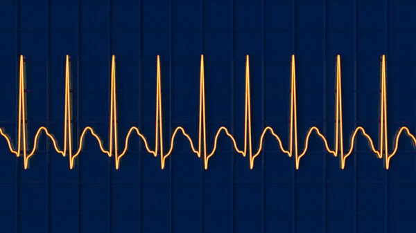 Ecg Aleteo Auricular Ritmo Cardíaco Anormal Caracterizado Por Contracciones Rápidas —  Fotos de Stock