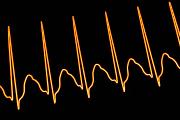 アトリアの急速かつ規則的な収縮によって特徴付けられる異常な心臓リズムの外科フラッターのEcg 特徴的なソトースP波と不規則な心室リズムを表示する3Dイラスト — ストック写真
