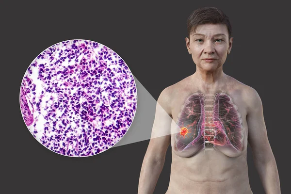 A woman with lung cancer, 3D illustration, along with a micrograph image of small cell lung cancer.
