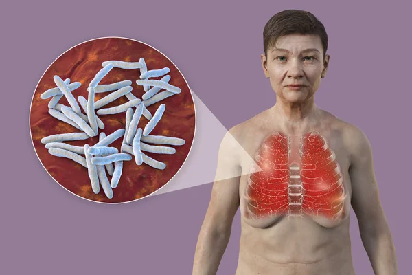 A 3D illustration showing a female patient with transparent skin, revealing the lungs affected by miliary tuberculosis and close-up view of Mycobacterium tuberculosis bacteria.
