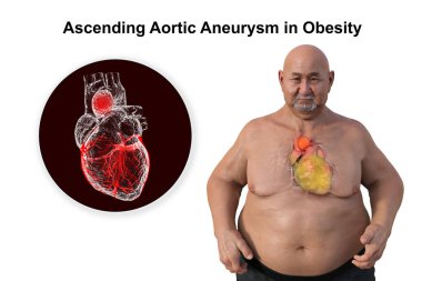 3D bilimsel illüstrasyon, saydam derili obez bir adamı, yükselen bir aort anevrizmasını, obezite ile yükselen aort anevrizmasının ilişkisini vurgulayan bir konsepti gözler önüne seriyor..