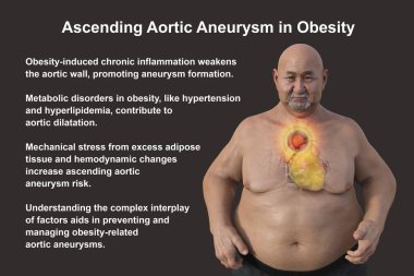 3D bilimsel illüstrasyon, saydam derili obez bir adamı, yükselen bir aort anevrizmasını, obezite ile yükselen aort anevrizmasının ilişkisini vurgulayan bir konsepti gözler önüne seriyor..