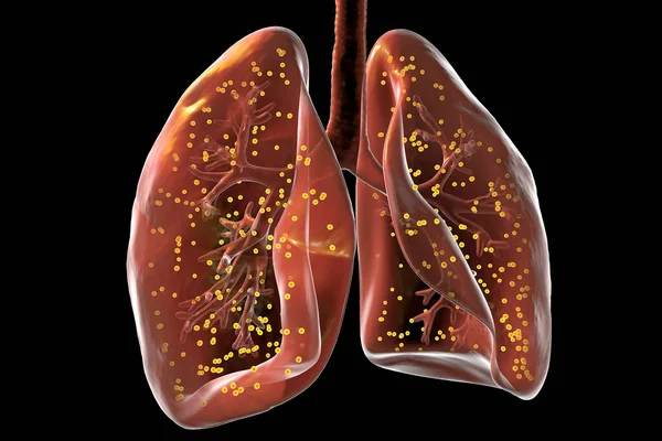 一种详细的三维摄影写实图 展示了千年虫肺结核对人类肺的影响 — 图库照片