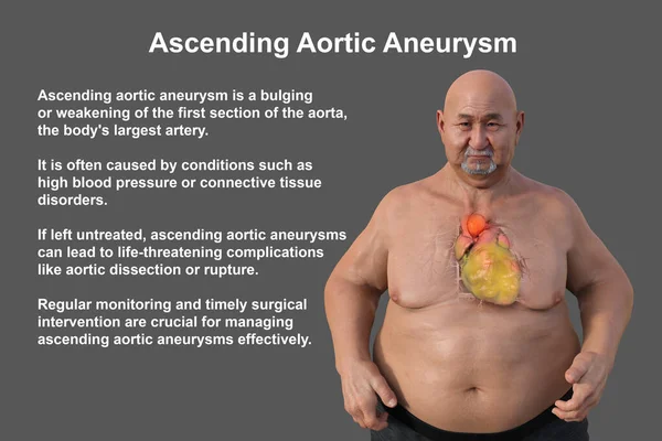 3D scientific illustration depicting an obese man with transparent skin, revealing an ascending aortic aneurysm, a concept highlighting the association of ascending aortic aneurysm with obesity.
