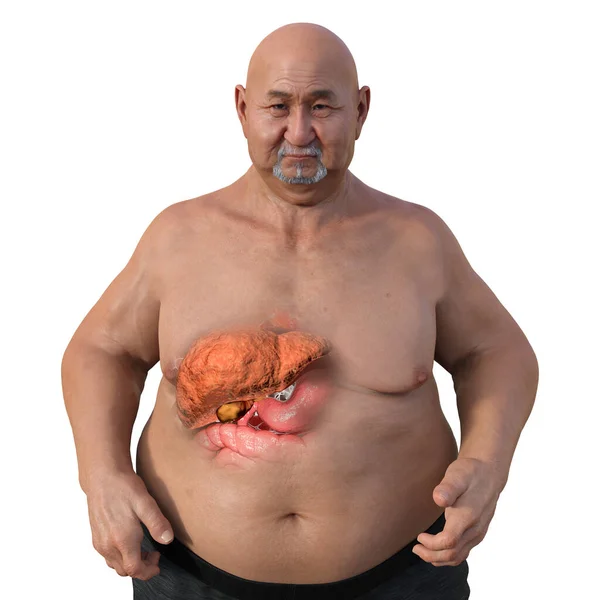 stock image A 3D medical illustration featuring an overweight man with transparent skin, showcasing the liver and highlighting the presence of liver steatosis.