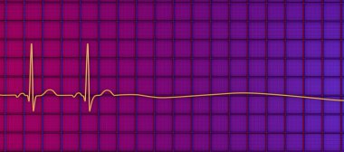 Asistol, kardiyak elektriksel aktivite yokluğunun işaretlediği kritik bir durum. 3D çizimler EKG 'de nabız ve kalp atışı olmayan işlevsiz bir kalp olduğunu gösteriyor..