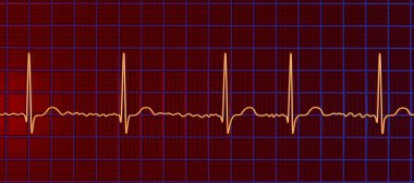ECG in atrial fibrillation (AFib), a 3D illustration depicts irregular rhythm, absent P waves, and rapid, chaotic atrial activity, posing a risk of palpitations and stroke. clipart
